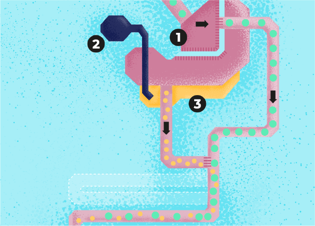 Infografik eines Magenbypass